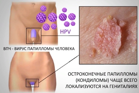 A HPV-fertőzés tünetei nőkben és férfiakban - Medicover