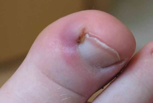 Насколько опасно самостоятельное удаление вросшего ногтя